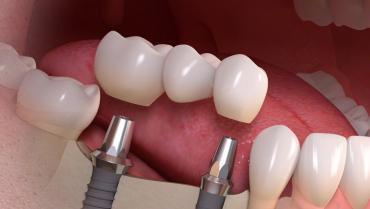Dental Implants